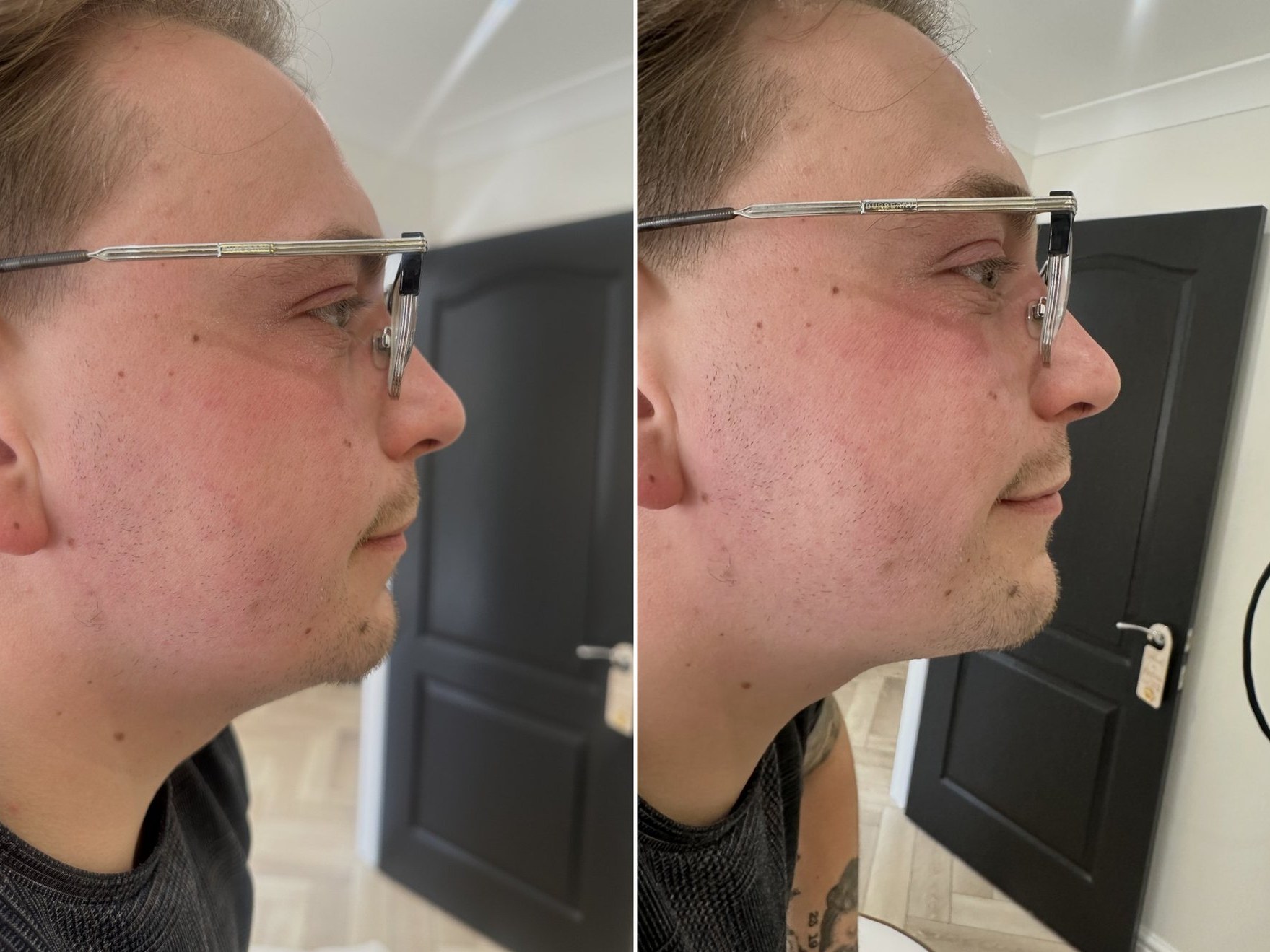 Before and after: Dermal Fillers, chin filler, male