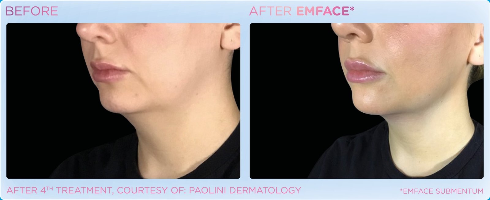 Before and after: EMFACE, under the chin, female
