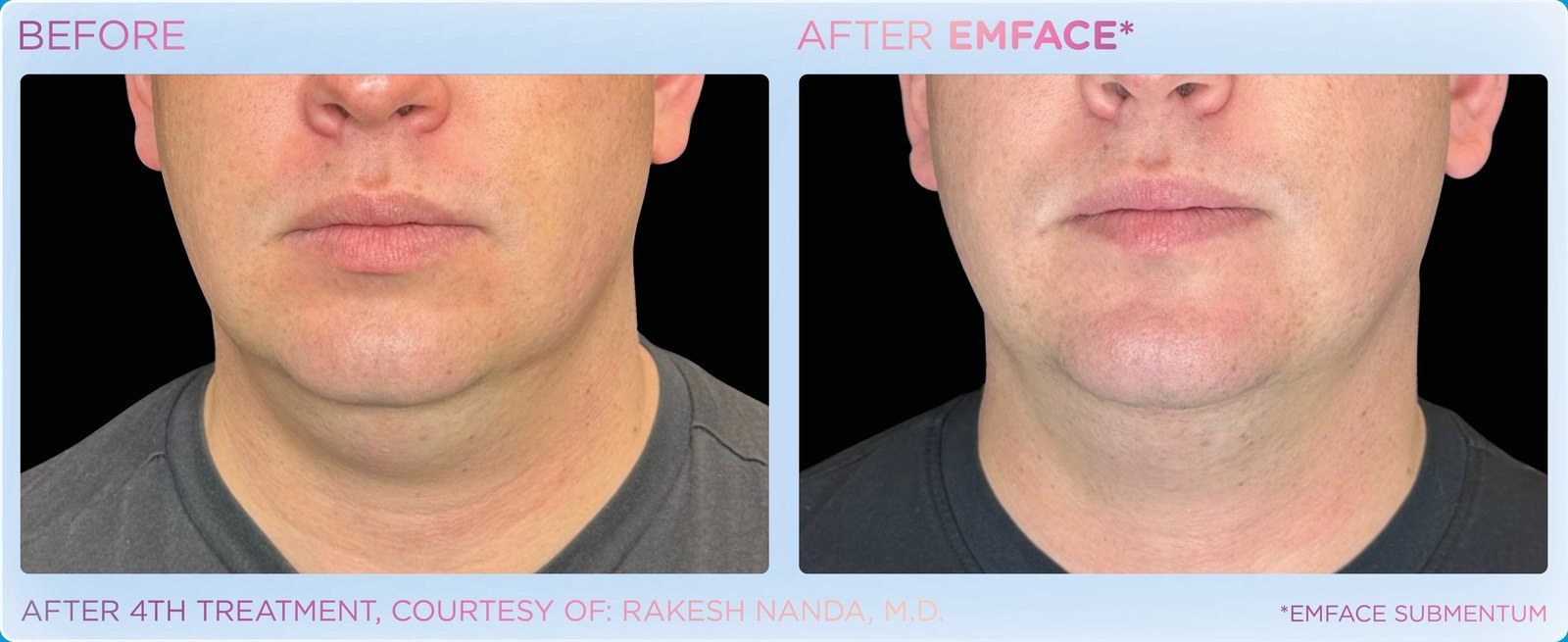 Before and after: EMFACE, under the chin, male