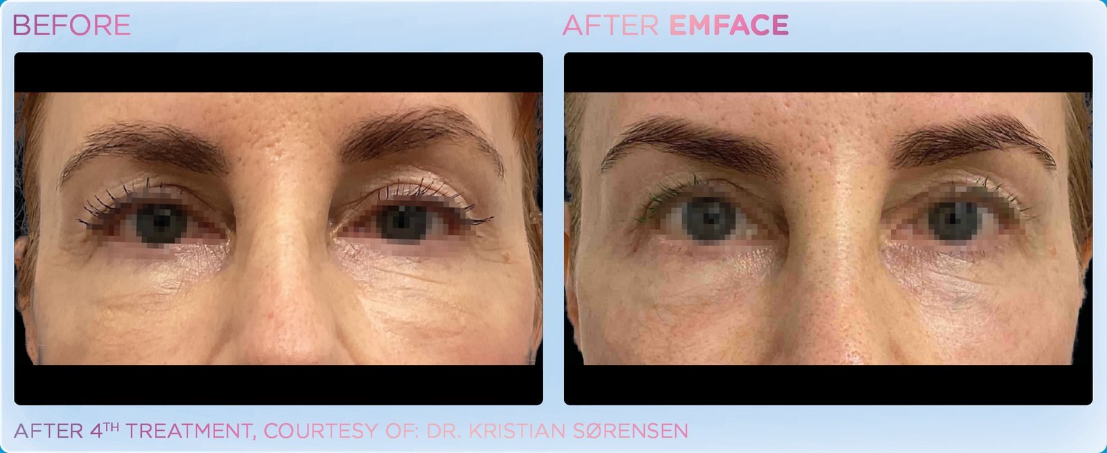 Before and after: EMFACE, eye area, female