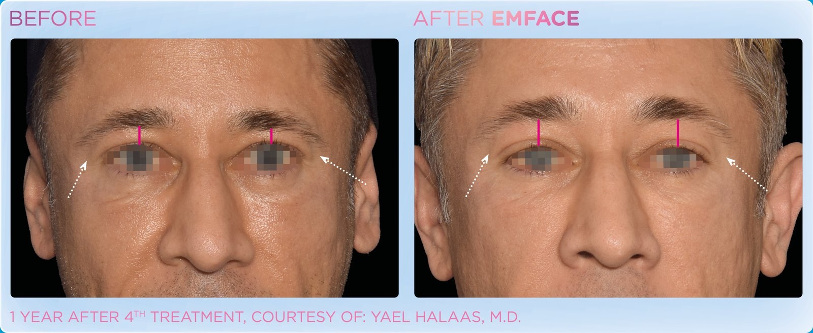 Before and after: EMFACE, eye area, male