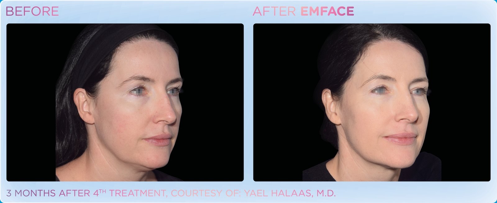 Before and after: EMFACE, full face, female