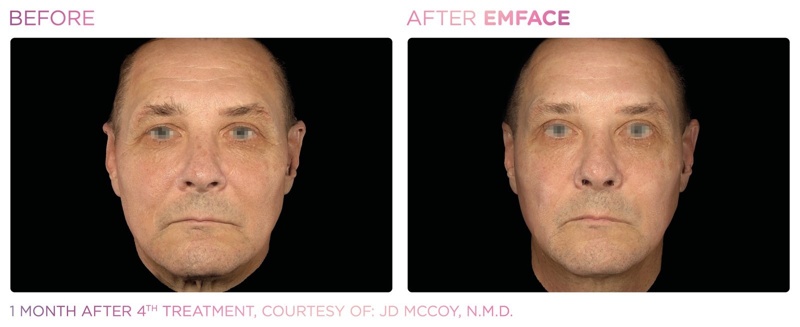 Before and after: EMFACE, full face, male