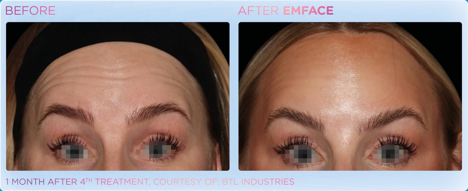 Before and after: EMFACE, forehead, female