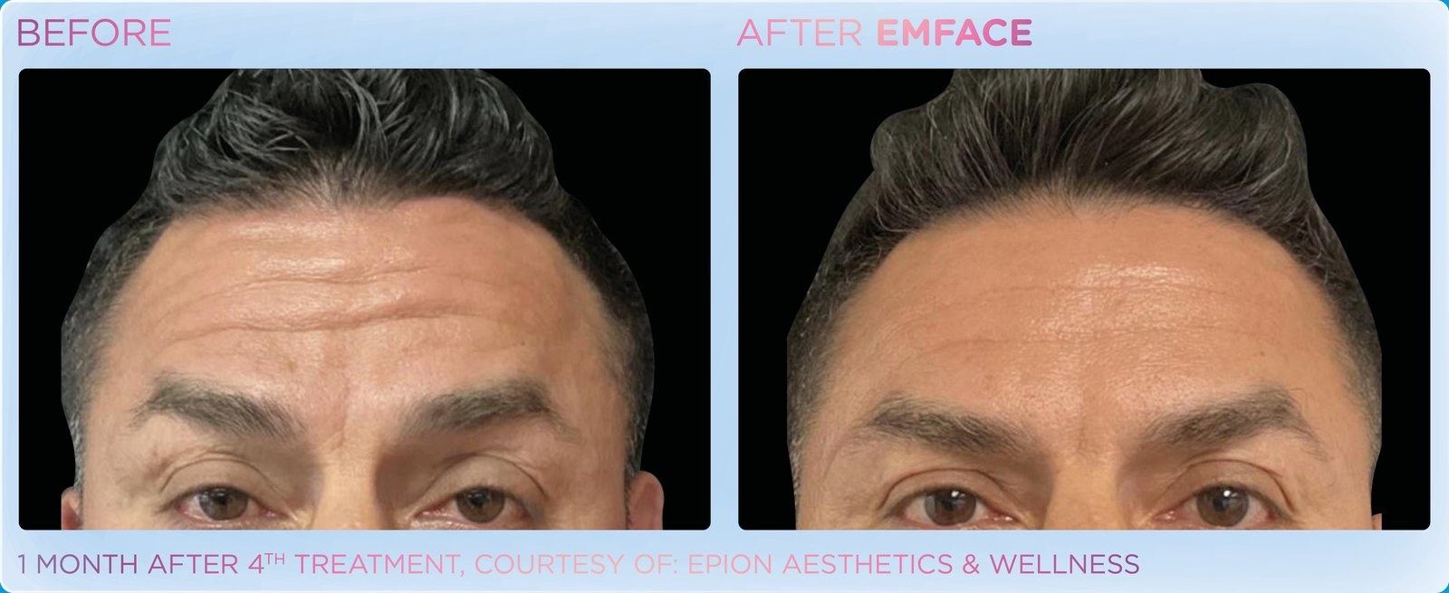 Before and after: EMFACE, forehead, male