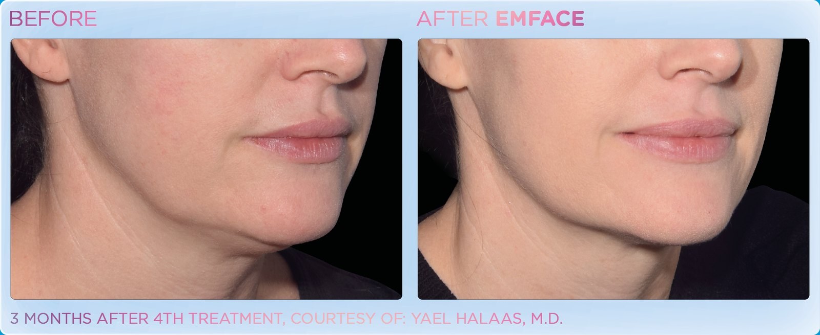 Before and after: EMFACE, jawline, female