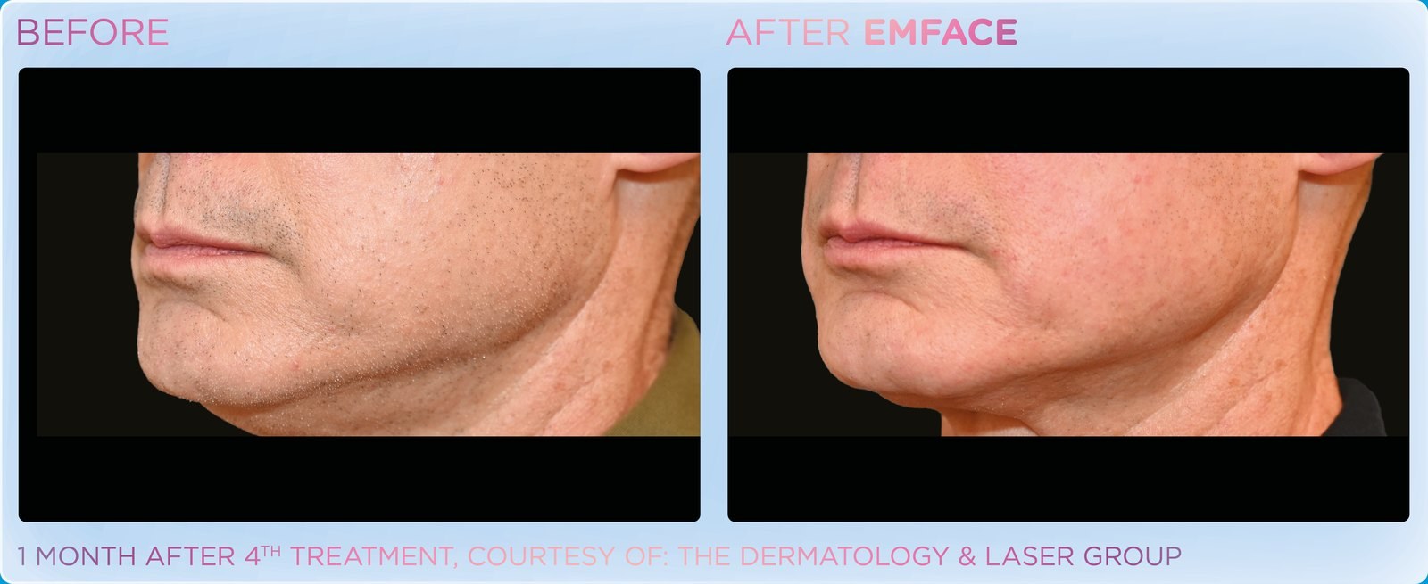 Before and after: EMFACE, jawline, male