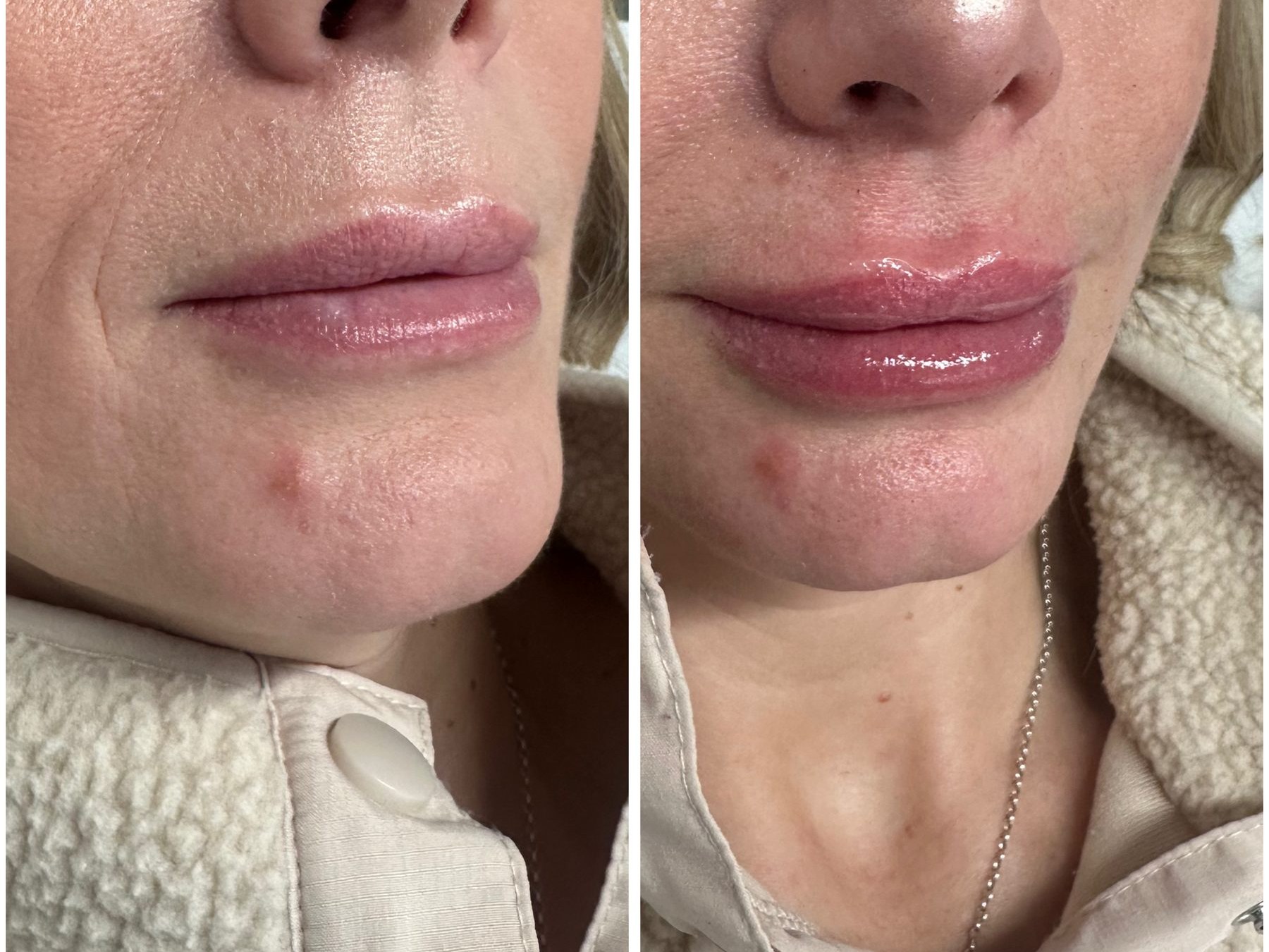 Before and after: Dermal Fillers, lip filler