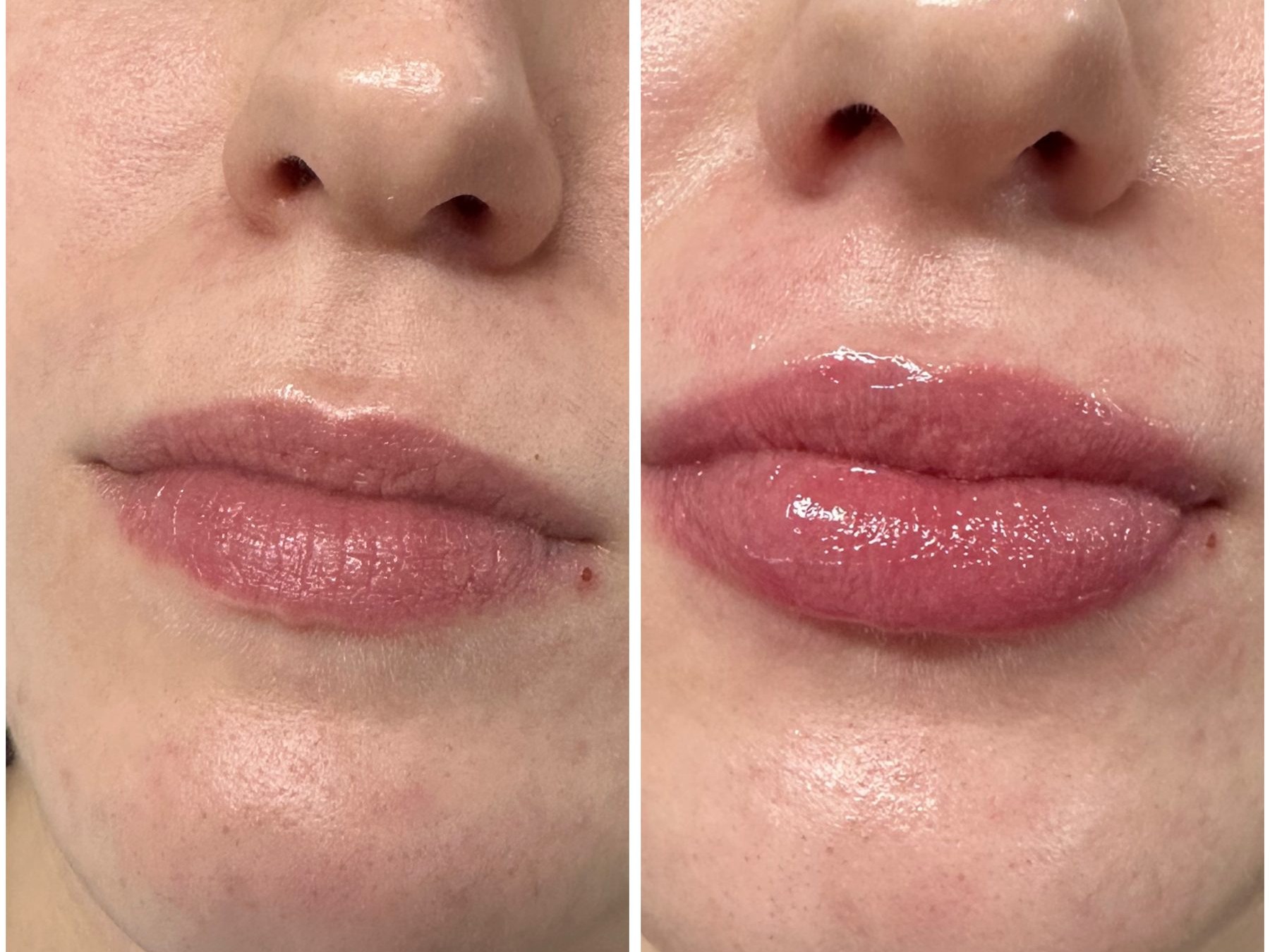Before and after: Dermal Fillers, lip filler