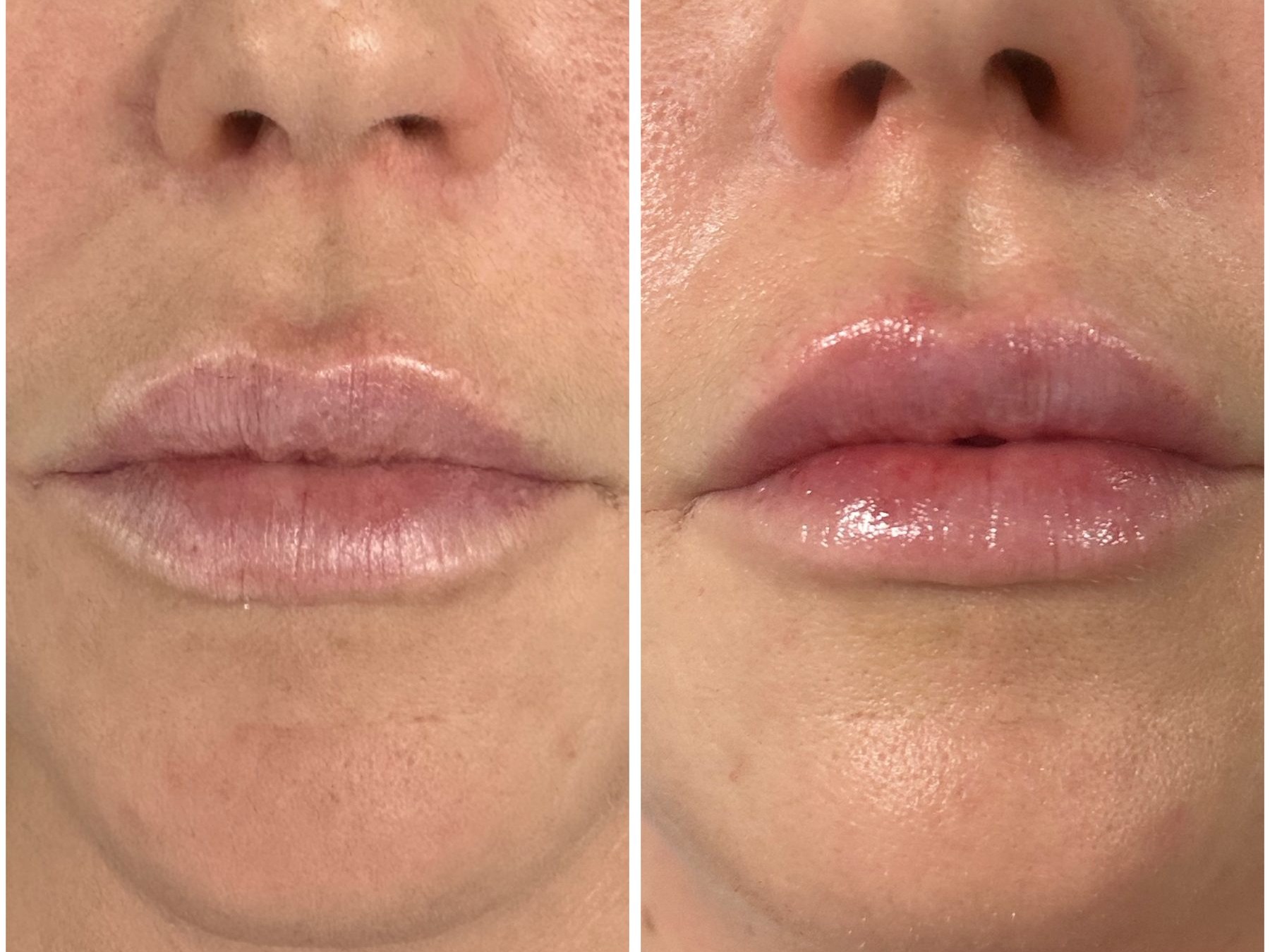 Before and after: Dermal Fillers, lip filler