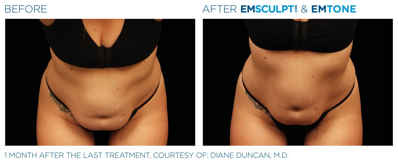 Before and after: EMSCULPT NEO, abdomen, female