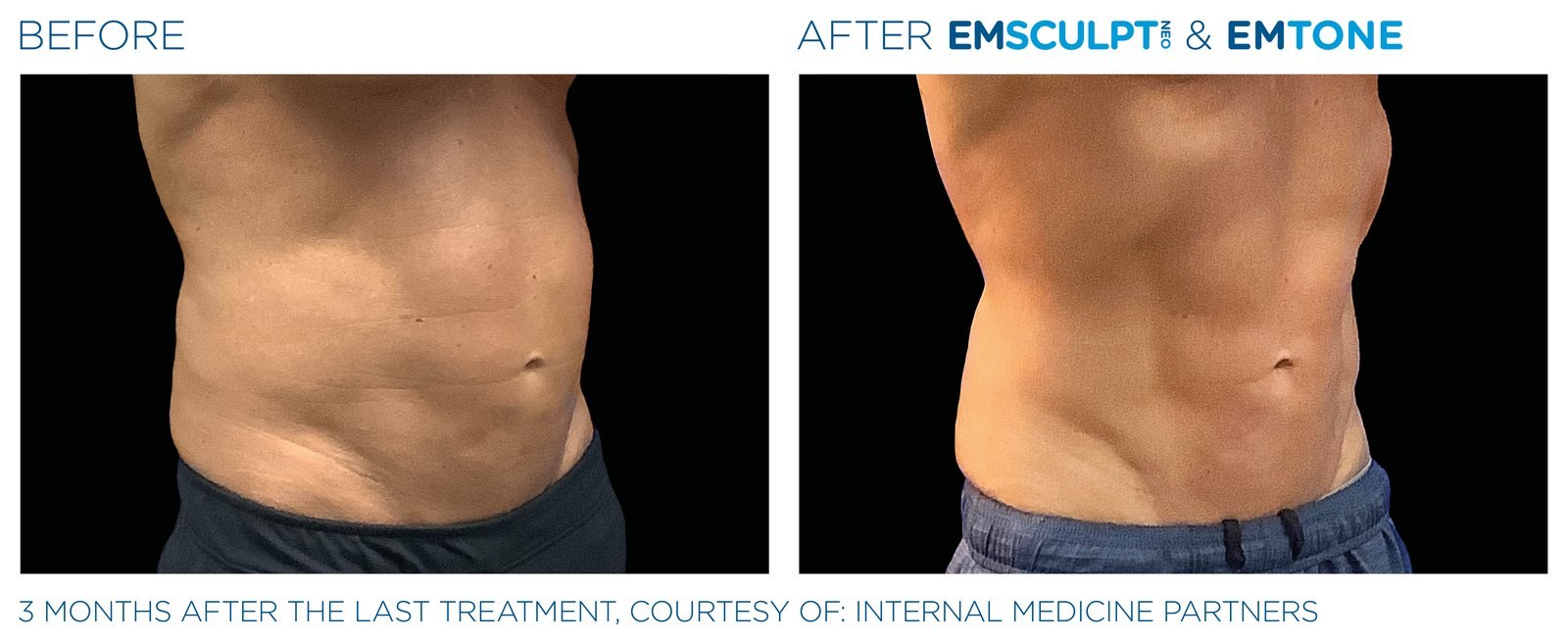 Before and after: EMSCULPT NEO, abdomen, male