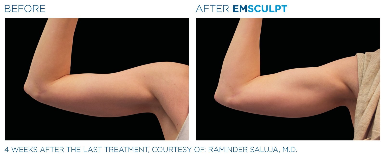 Before and after: EMSCULPT NEO, arms, female