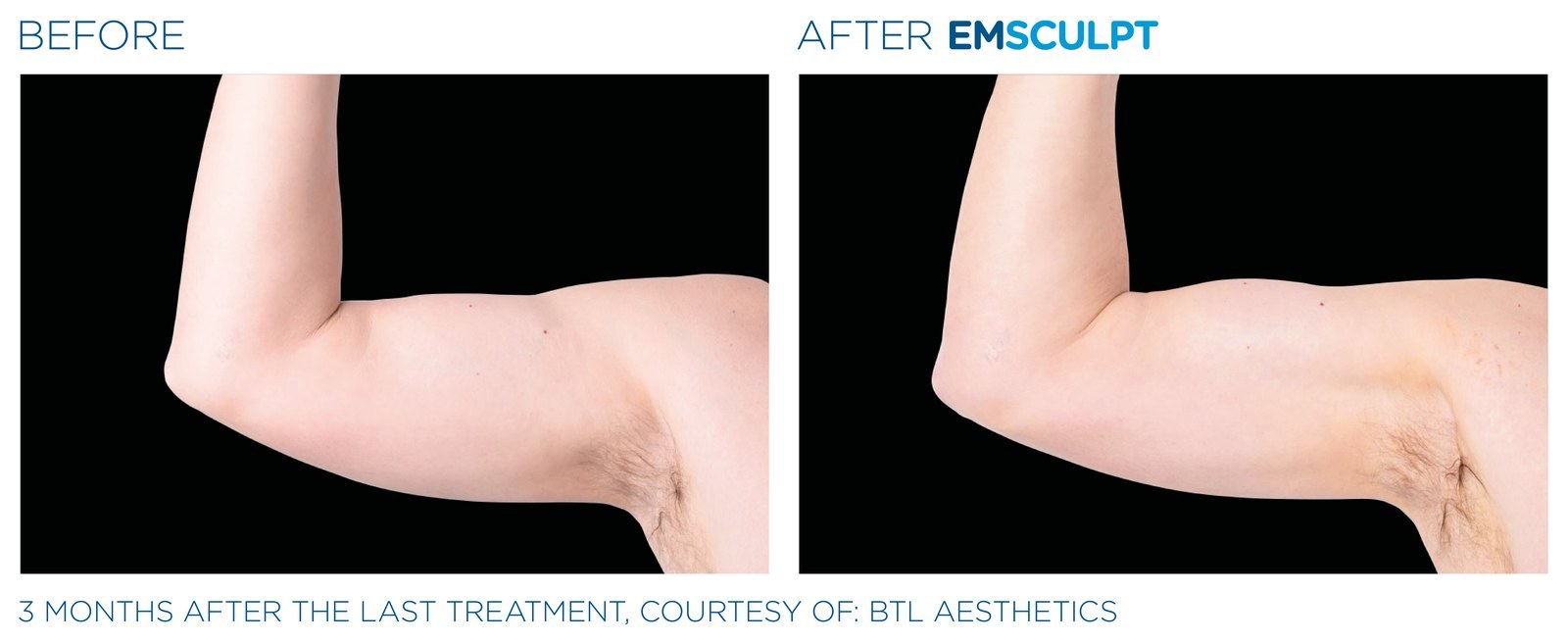 Before and after: EMSCULPT NEO, arms, male