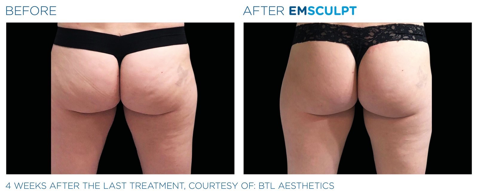 Before and after: EMSCULPT NEO, buttocks, female