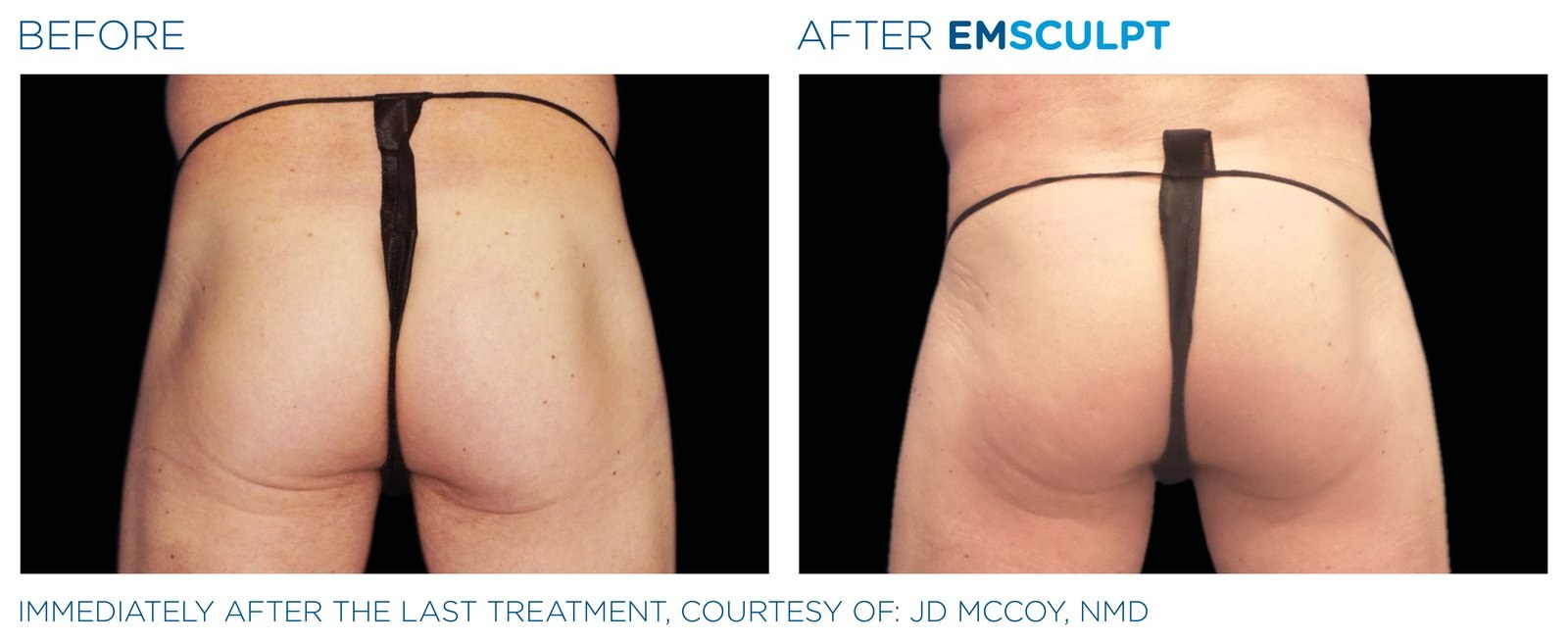 Before and after: EMSCULPT NEO, buttocks, male