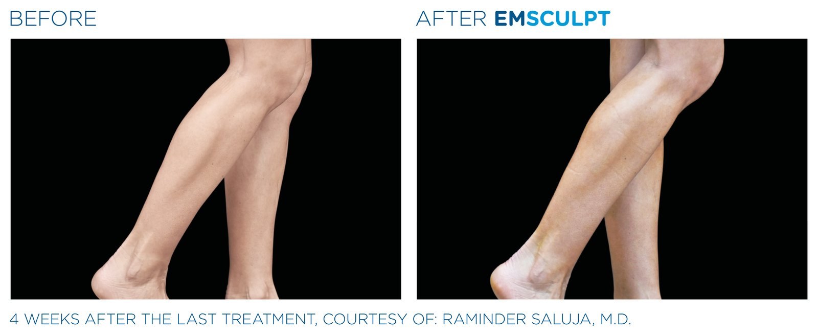 Before and after: EMSCULPT NEO, calves, female