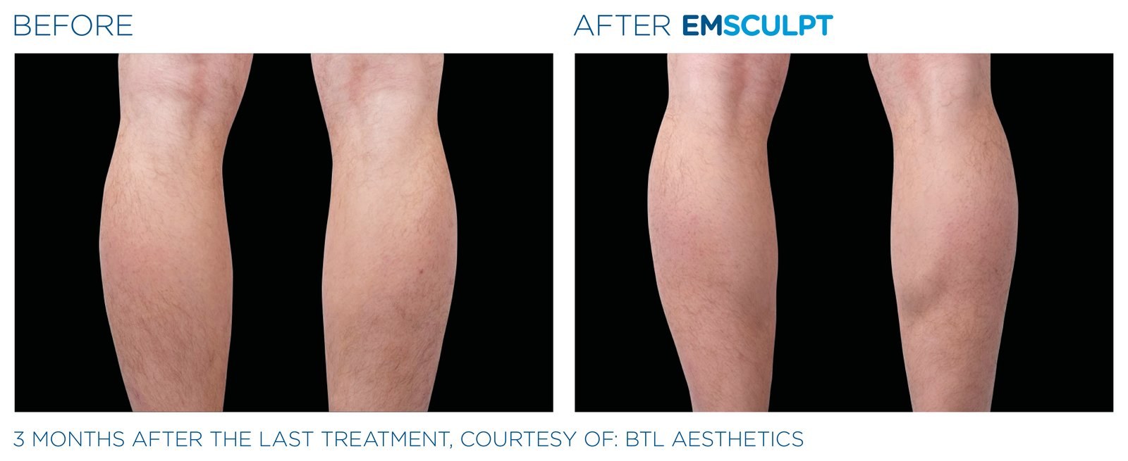 Before and after: EMSCULPT NEO, calves, male