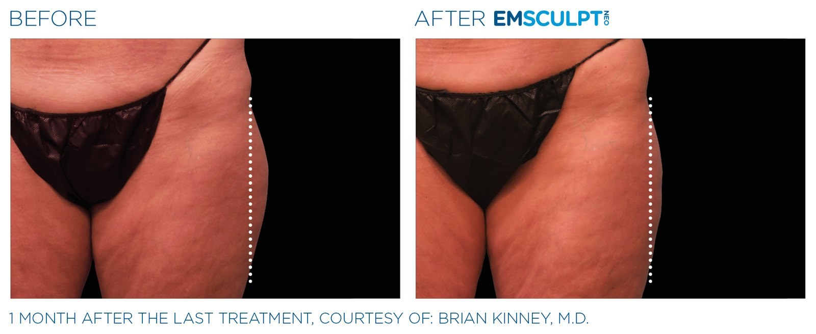 Before and after: EMSCULPT NEO, outer thighs, female