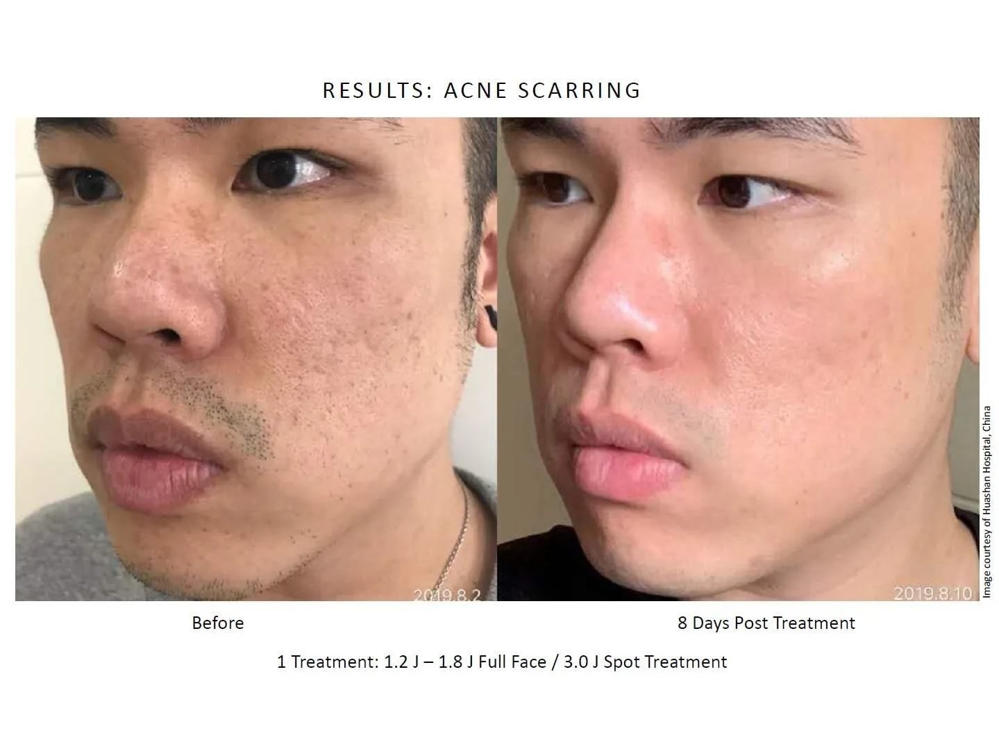 Before and after: NeoGen Plasma, acne scarring, male