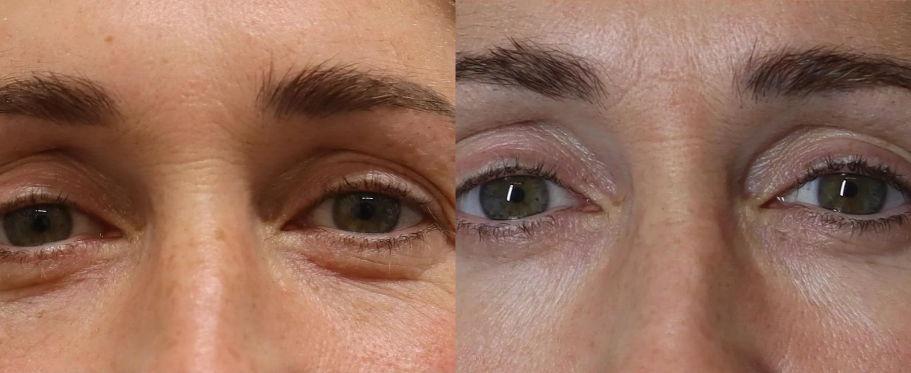 Before and after: NeoGen Plasma, eye area, female