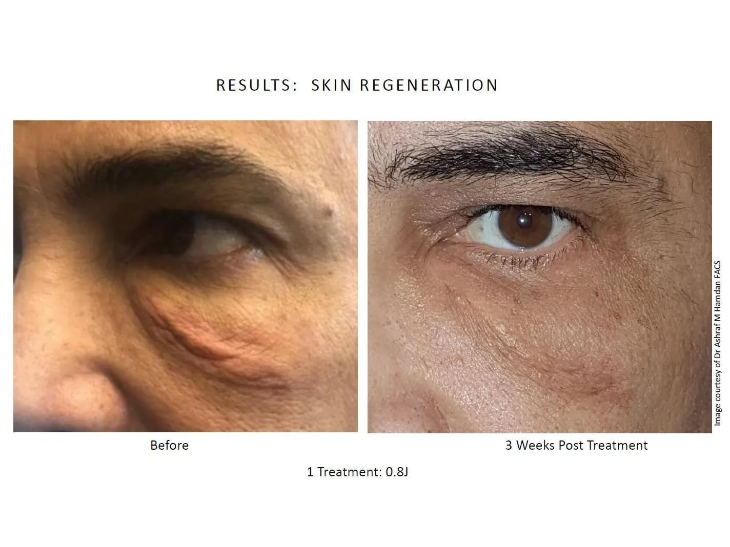 Before and after: NeoGen Plasma, eye area, male