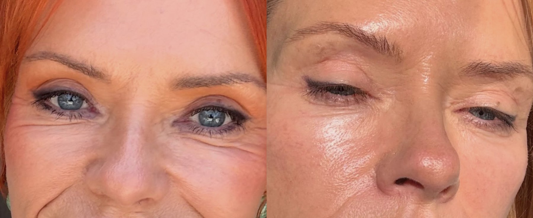 Before and after: NeoGen Plasma, eye area after one treatment, female