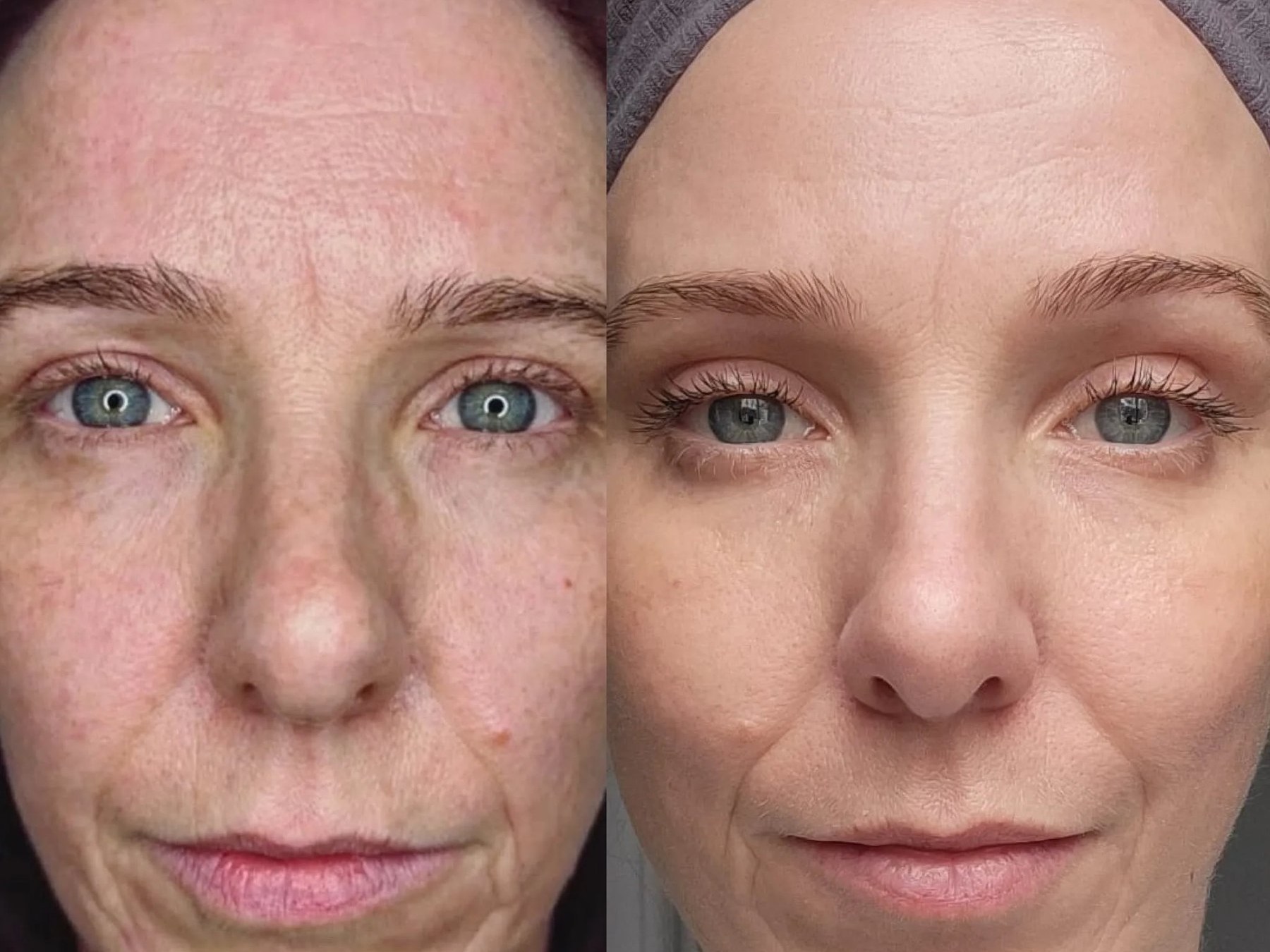 Before and after: NeoGen Plasma, full face and eyes, female