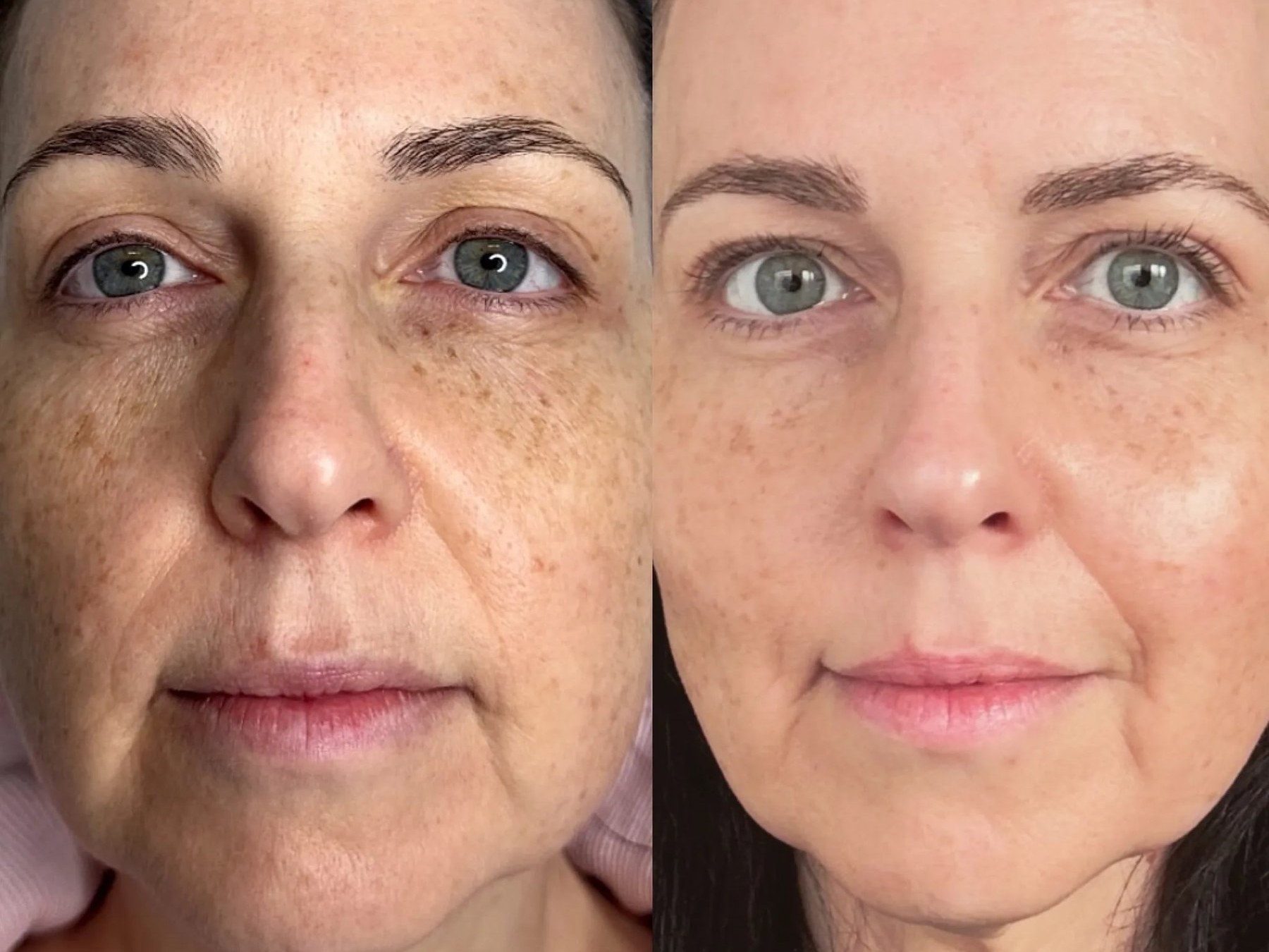 Before and after: NeoGen Plasma, full face, female
