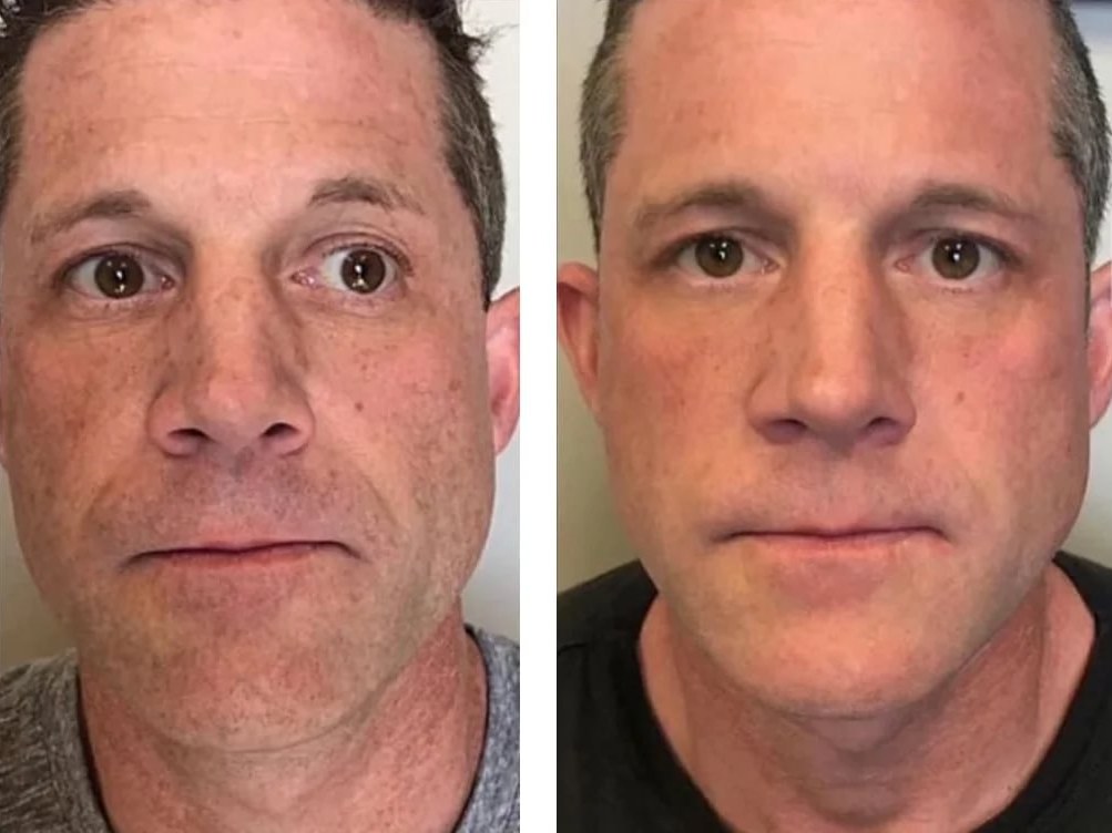Before and after: NeoGen Plasma, full face, male