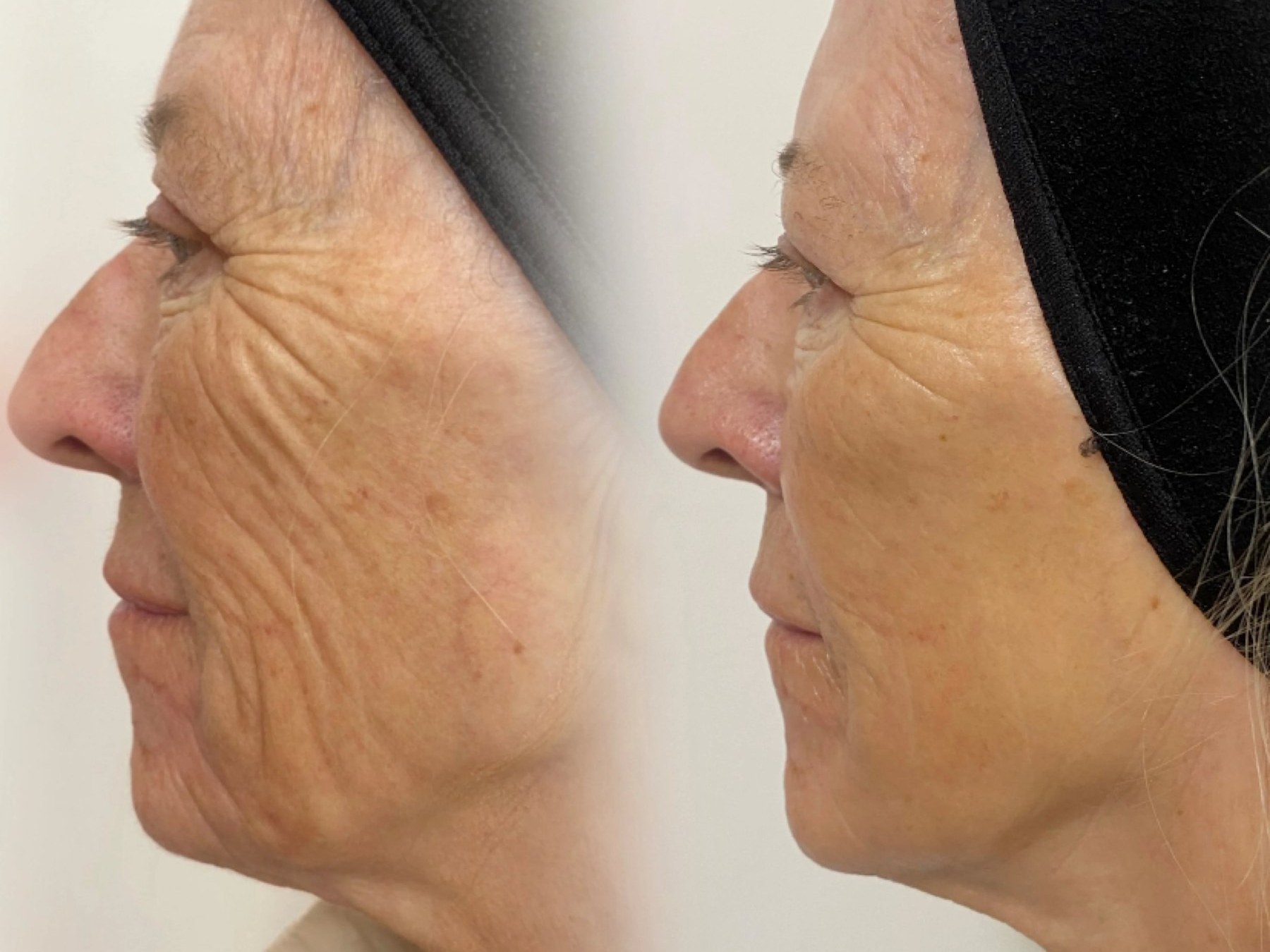 Before and after: NeoGen Plasma, deep lines and laxity, female