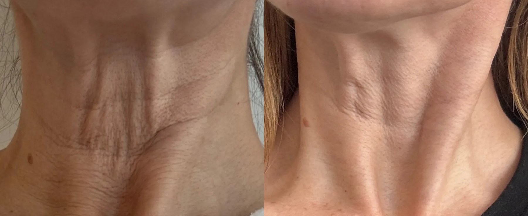 Before and after: NeoGen Plasma, neck and jawline, female