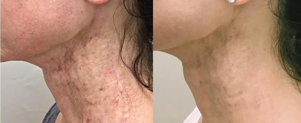 Before and after: NeoGen Plasma, neck, texture and pigmentation, female