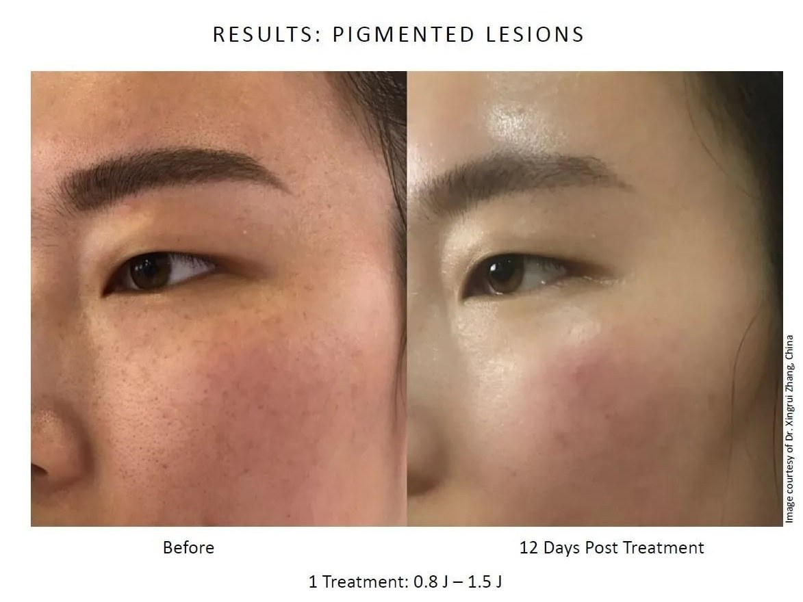 Before and after: NeoGen Plasma, pigmented lesions, female