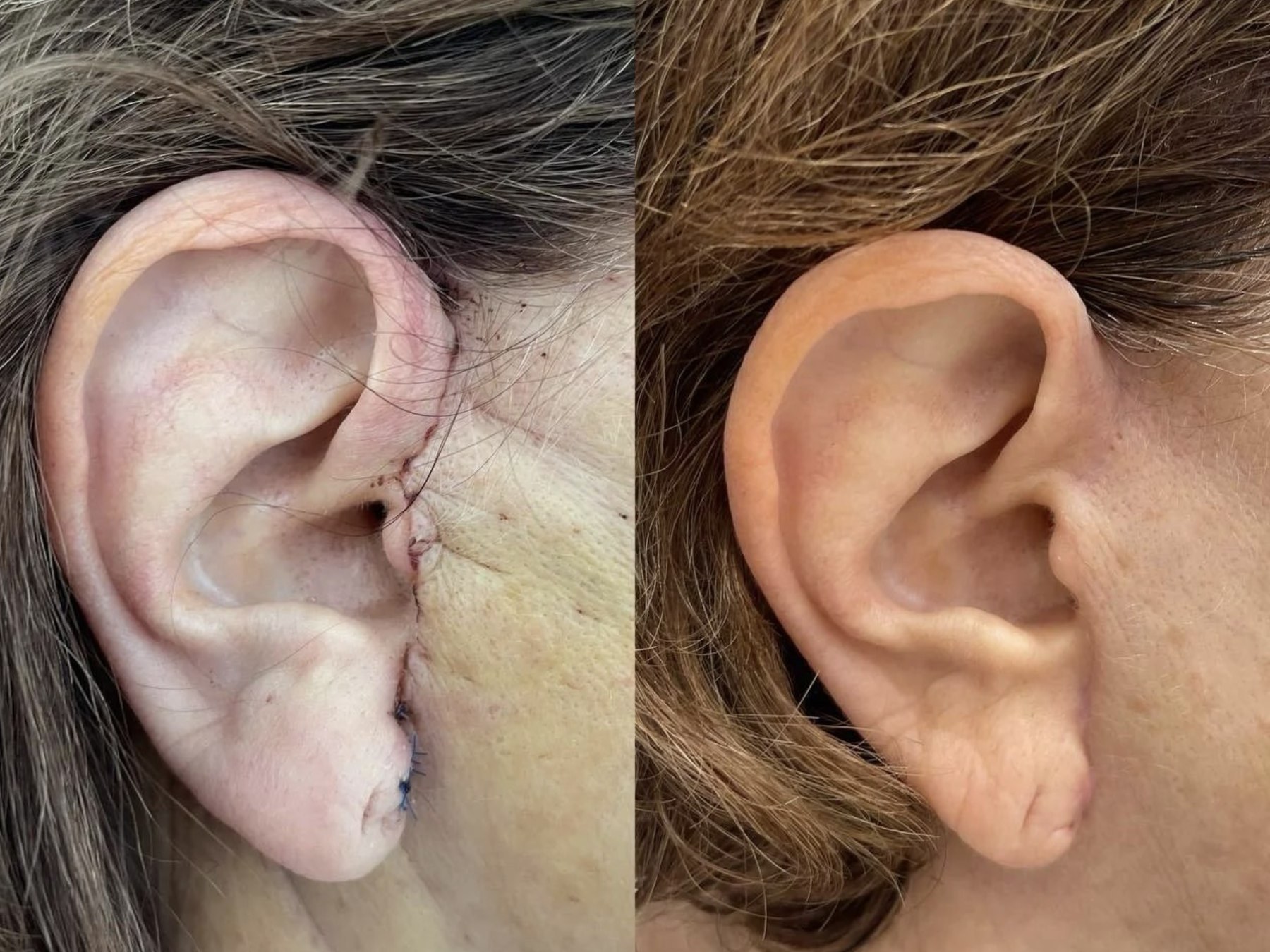 Before and after: NeoGen Plasma, scarring, in front of the ear