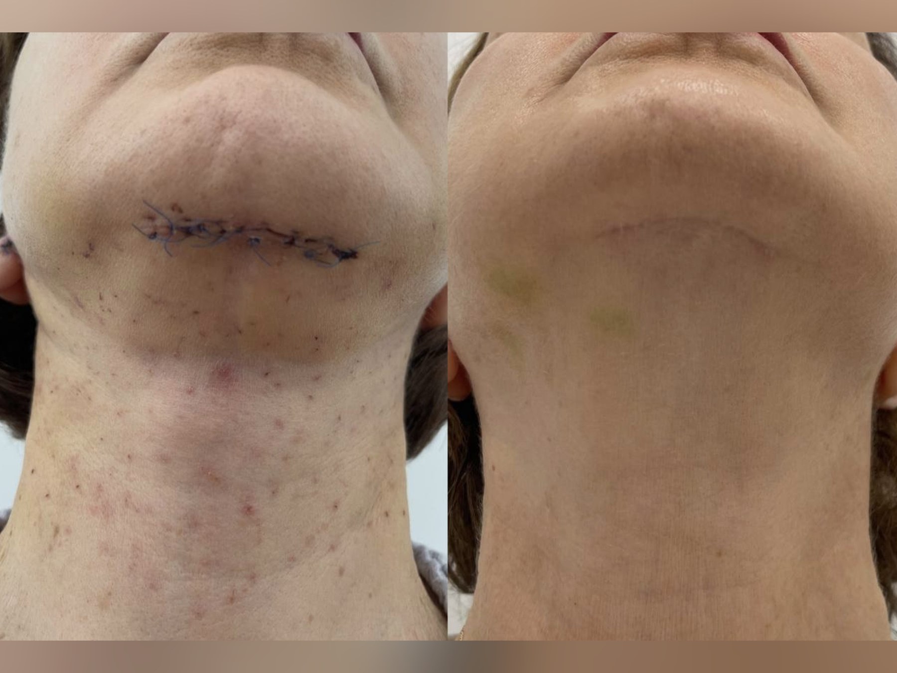 Before and after: NeoGen Plasma, surgical scar, neck