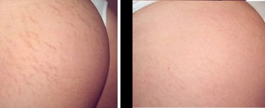 Before and after: NeoGen Plasma, stretch marks