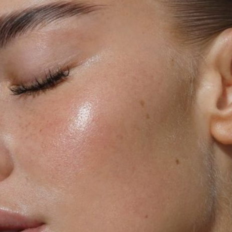 Advanced Microneedling with skin booster
